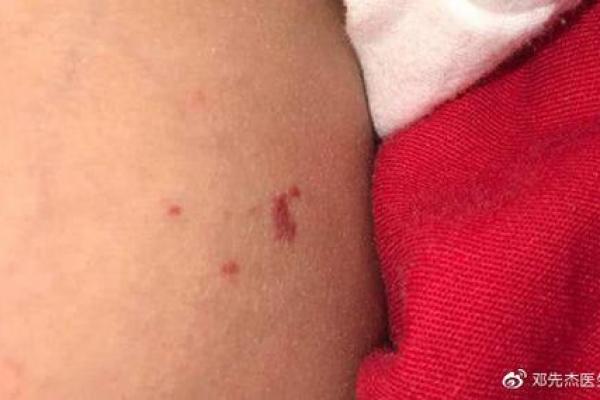 红色的胎记算命