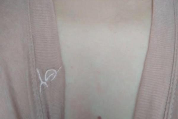 胸部痣相图解算命