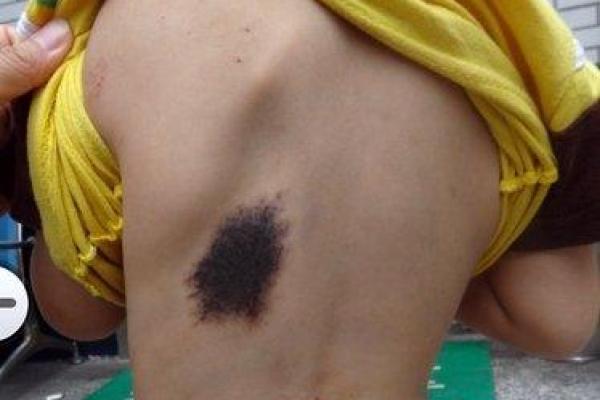 胎记算命：从胎记看运势